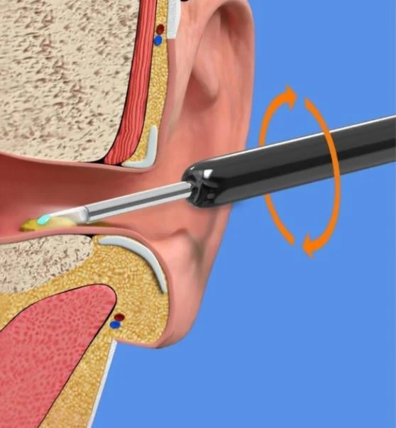 (🔥Promotion 50% OFF) Clean Earwax - Wi -Fi Visible Wax Elimination Spoon,USB 1080P HD Load Otoscope - Image 5